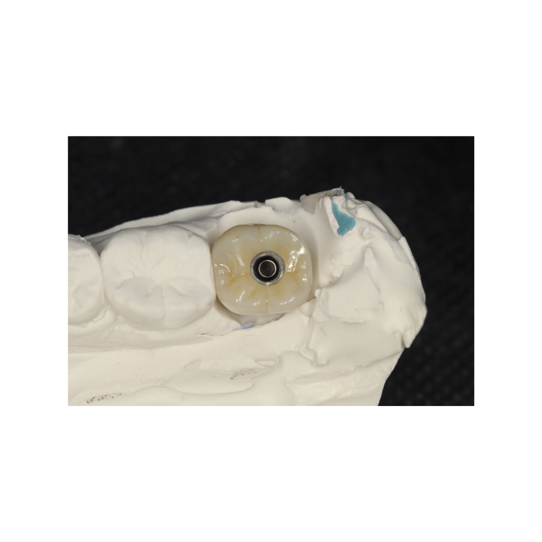 Custom implant crown restoration